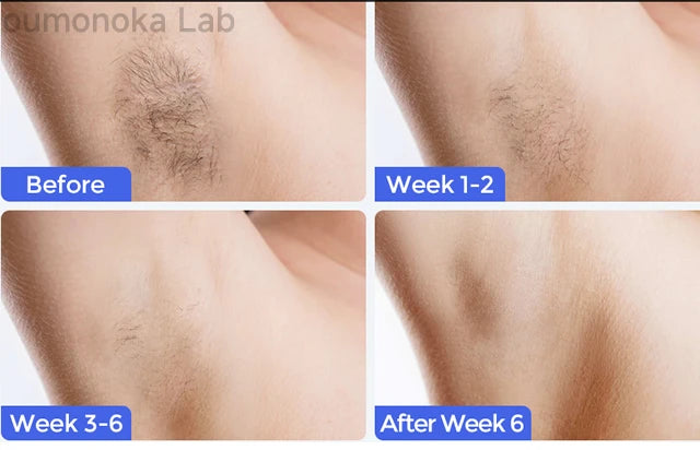 SilkaLaser™ Precision Hair Removal System