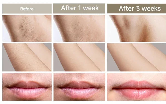 SilkaLaser™ Precision Hair Removal System